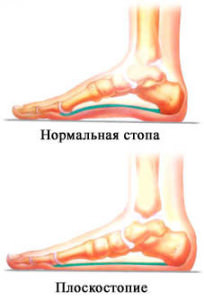 Пешие прогулки против плоскостопия