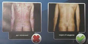 psoriaz3