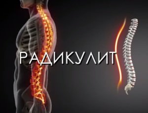 Как радикулит возникает?